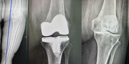 مستشفى الدكتور سليمان الحبيب بالخبر يُجري عملية دقيقة بالروبوت الجراحي لإعادة قدرة المشي لمراجعة "تسعينية" - جورنالك السعودي