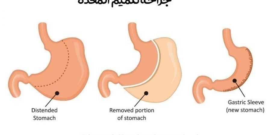 مميزات وعيوب تكميم المعدة - جورنالك