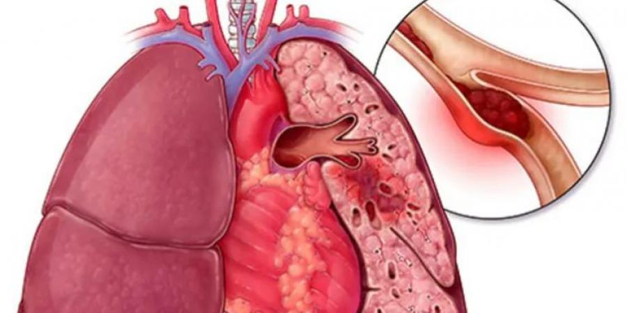 تلوث الهواء يسبب الانسداد الرئوي المزمن .. الصحة العالمية تحذر - جورنالك