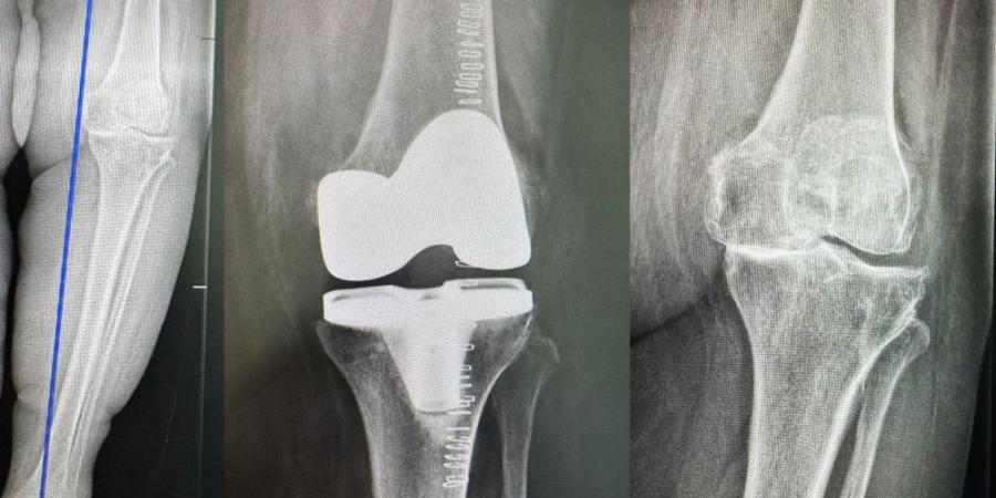 مستشفى الدكتور سليمان الحبيب بالخبر يُجري عملية دقيقة بالروبوت الجراحي لإعادة قدرة المشي لمراجعة "تسعينية" - جورنالك السعودي